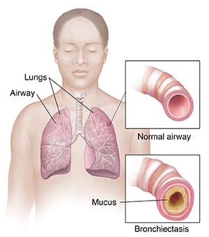 Front view of woman showing respiratory system. Insets show normal airway and airway with bronchiectasis.