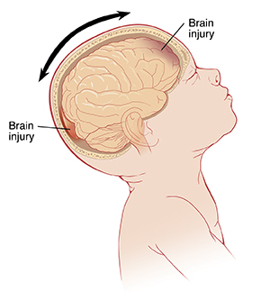 Side view of baby with head tilted back, showing brain inside. Arrows show head moving back and forth, and injuries at front and back of brain.