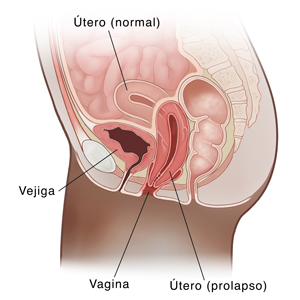 Vista lateral de corte transversal de la pelvis femenina donde se observa un útero con prolapso.