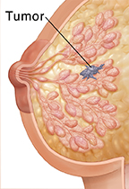 Cross section of breast showing invasive breast cancer.