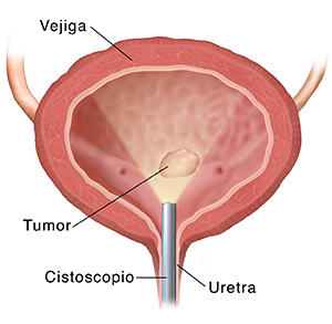 Corte transversal de vista frontal de la vejiga en donde se ve un citoscopio insertado a través del uréter.